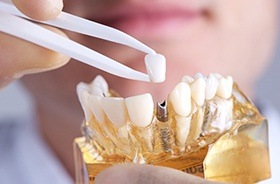 Model of implant dental crown