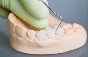 Model smile with fixed bridge restoration