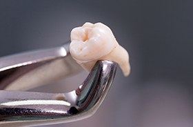 Clasp holding extracted tooth